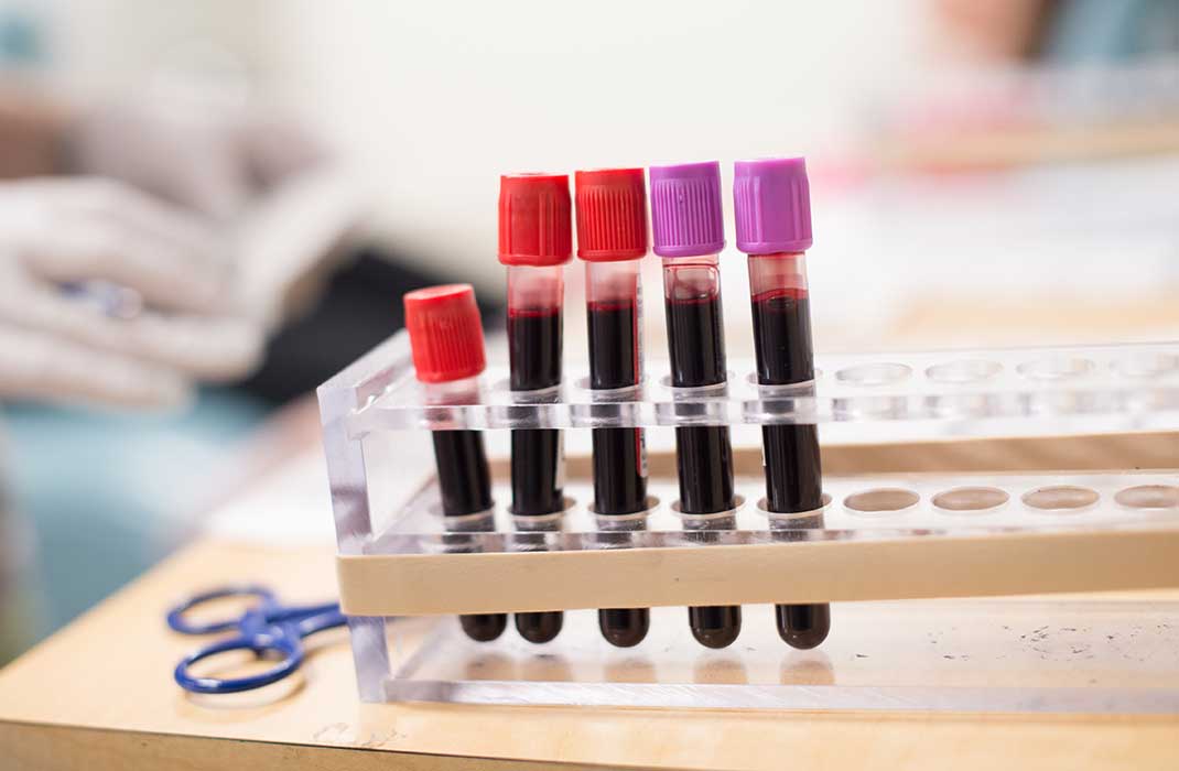 New Research from Mass General Brigham Guides Treatment Regimen for Aggressive Blood Cancer